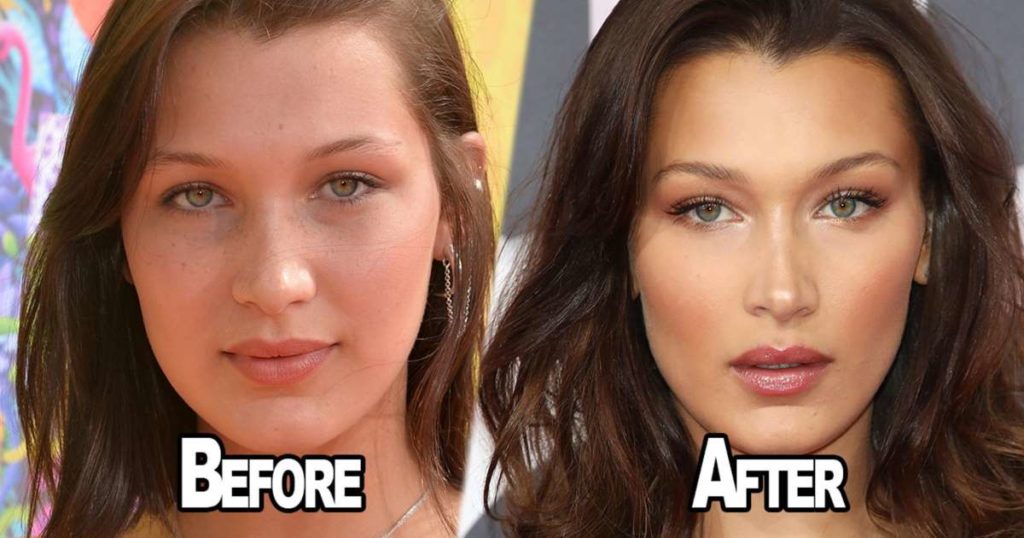 Bella Hadid OPENS UP about having Plastic Surgery!